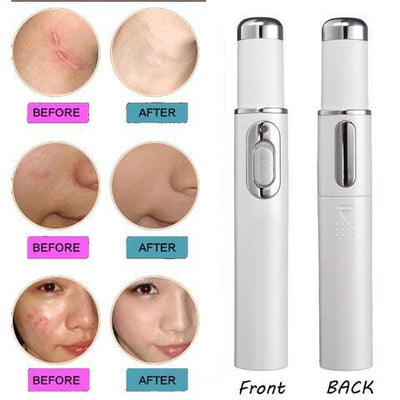 Blue Light Acne Therapy Pen – Laser Device for Acne, Scars & Wrinkle Removal