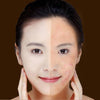 Blue Light Acne Therapy Pen – Laser Device for Acne, Scars & Wrinkle Removal